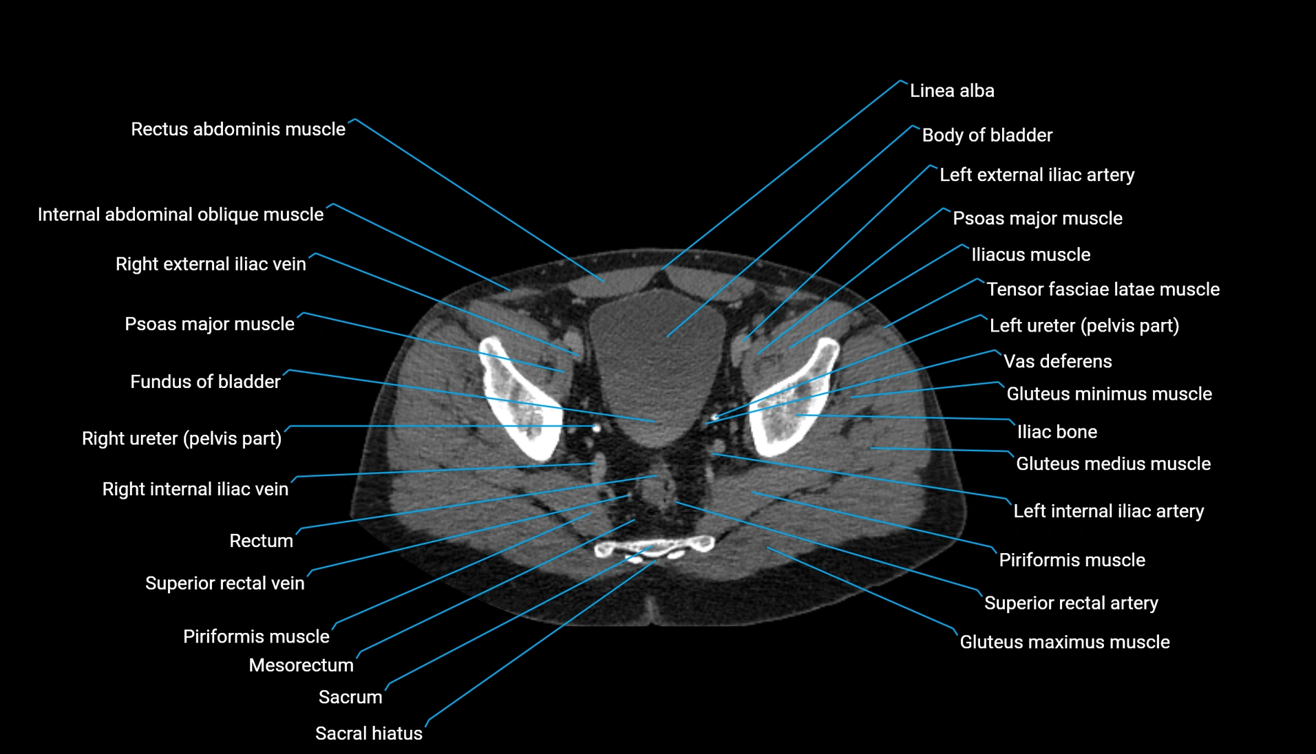 CT urogram axial cross sectional anatomy  labelled radiology image-00212.webp